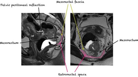 Mri Of Tumors And Tumor Mimics In The Female Pelvis Anatomic Pelvic Space Based Approach