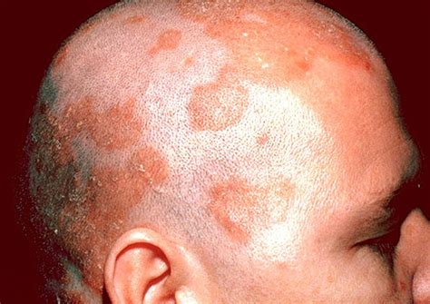 seborrheic dermatitis treatment - pictures, photos