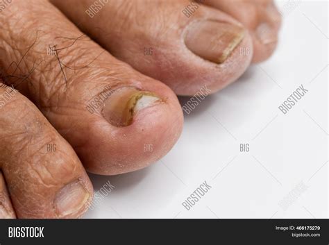 Damaged Toenail Image Photo Free Trial Bigstock