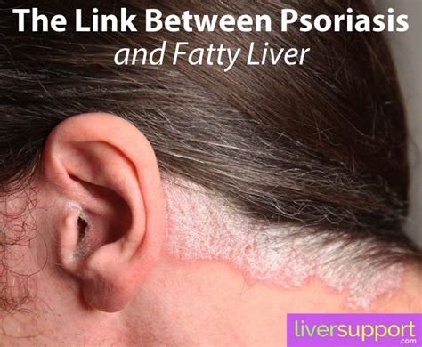 Pin On Liver Health News