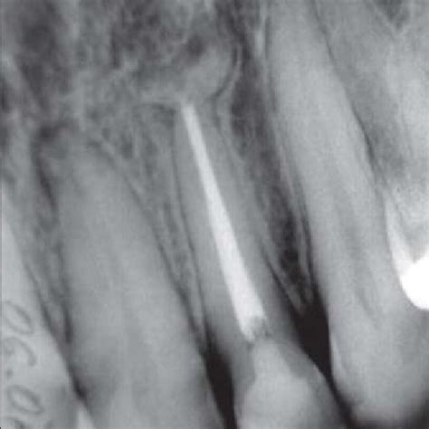 Radiograph Taken Month After The Beginning Of The Nonsurgical Root