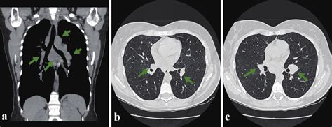 Thoracic Ct Scan Showing Multiple Mediastinal Adenopathies In All