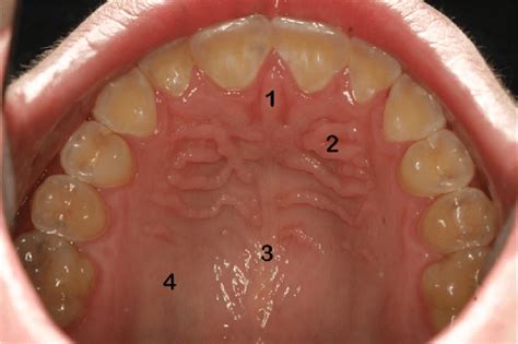 7 Porção anterior do palato duro Download Scientific Diagram