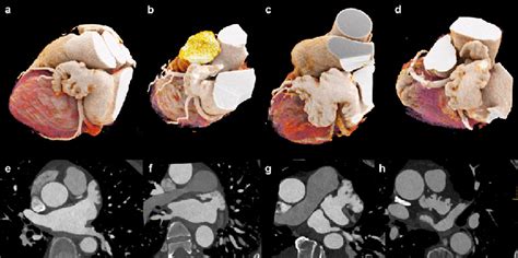 Types Of Left Atrial Appendage Configuration Cinematic 3d Rendering Download Scientific