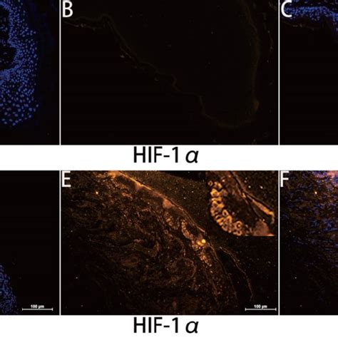 Immunohistochemical staining for hypoxia inducible factor 1α HIF 1 α