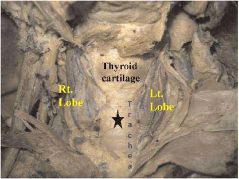 Photograph Showing Right And Left Lobe Of Thyroid Gland Black Star