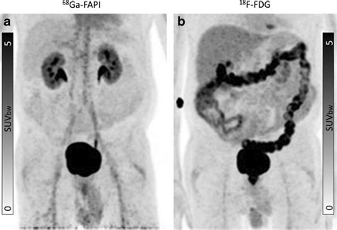 Intra individual comparison of ¹⁸F FDG and ⁶⁸Ga FAPI in a patient with