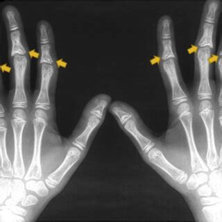 Hand X Ray Showing Coned Epiphyses In The Middle Phalanges Yellow