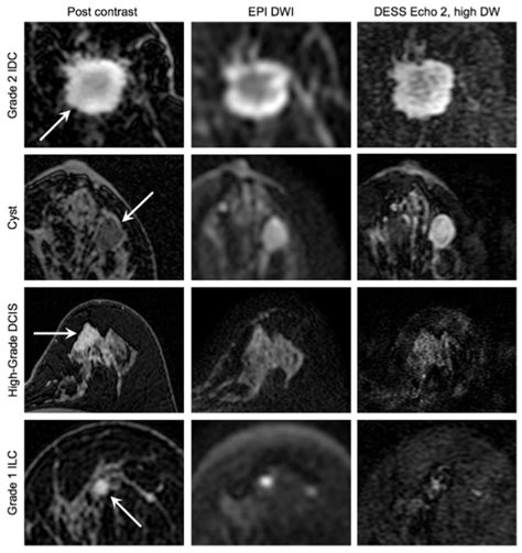 High Resolution 3d Diffusion Weighted Breast Mri With Dess Body Mri