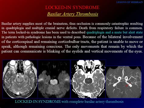 Basilar Artery Stroke