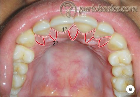 Periodontal Flap Surgeries Current Concepts