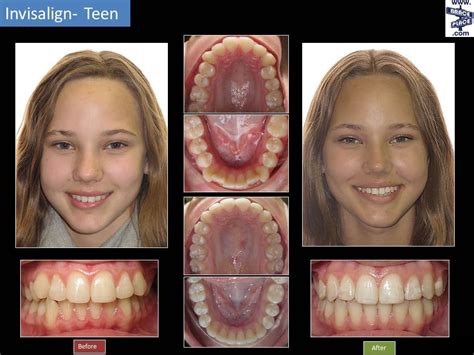 Clear Braces For Teeth Before And After