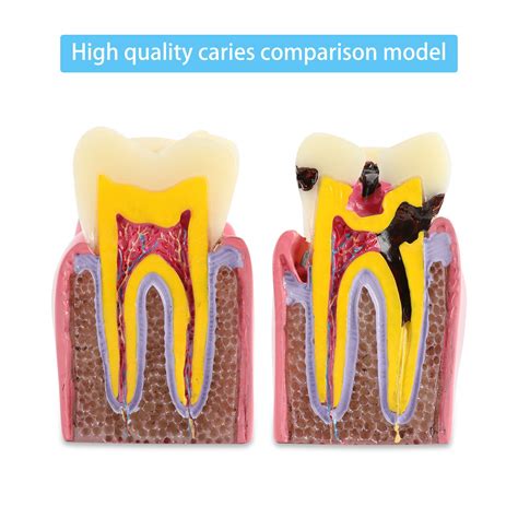 Buy Dental Caries Tooth Model 6 Times Decay Teeth Comparative Study