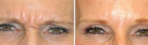 Botox Orlando Fl 1 Botox Injections Specials And Treatments