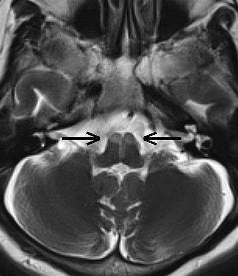 A Case Of Bilateral Stroke Of The Medulla Oblongata Journal Of