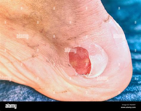 Nasty Burned Wound Removing Of Burned Skin From Attached Place At