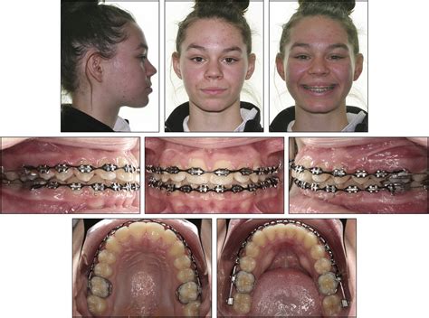 How Braces Work After Extraction Renay Grubbs