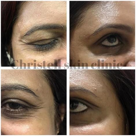 Pictures Of Botox Under Eyes (1) » Facial Injections: Info, Prices, Photos, Reviews, Q&A