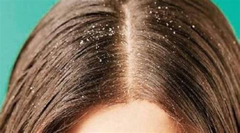 Troubled By Dandruff In The Winter Season You Can Get Rid Of These Home Remedies You Should Know