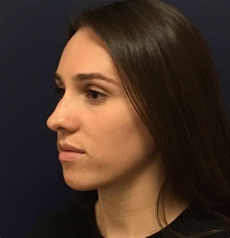 Rhinoplasty Before And After Photos By Brian Pinsky Md Facs