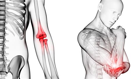 Artritis reumatoide dolor de articulaciones síntomas y tratamiento