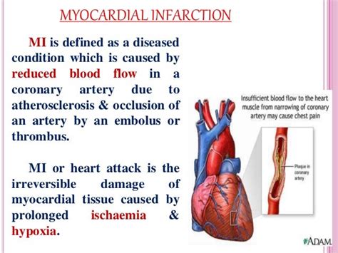 Myocardial Infarction