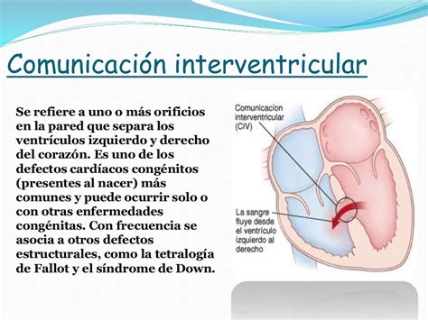 Comunicación Interventricular