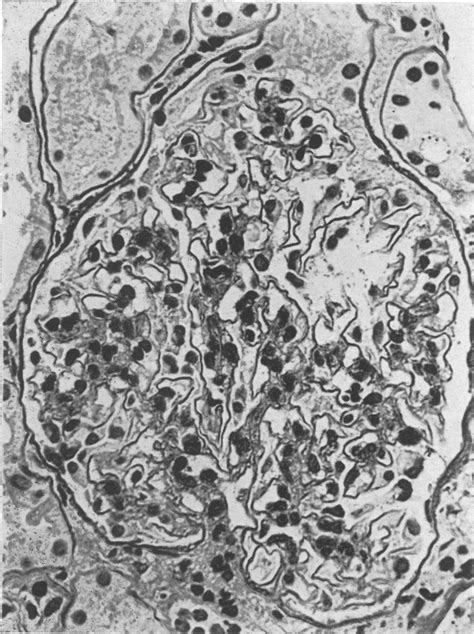 Acute Glomerulonephritis With Few Urinary Abnormalities Report Of Two