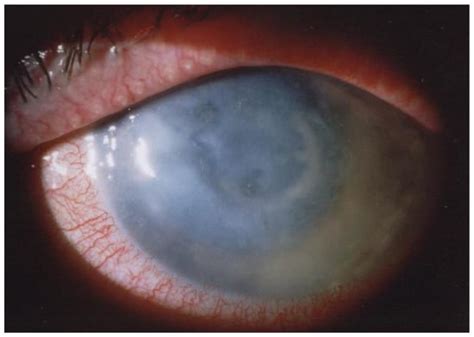 Microorganisms Free Full Text Understanding Acanthamoeba Keratitis An In Depth Review Of A