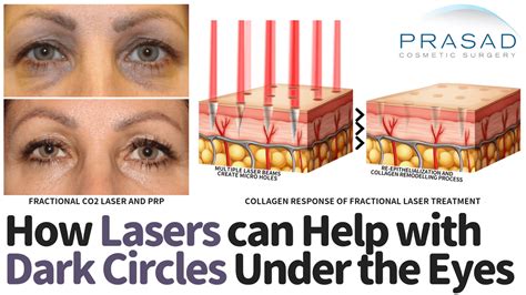 Laser Treatment for Dark Circles Under Eyes | Dr. Prasad Blog