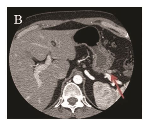 CT Of The Pancreas Showing Three Hyperenhancing Lesions A 4 Mm