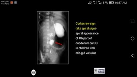 Corkscrew sign | Science biology, Signs, Math