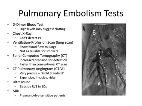 PPT - Group 1 Presentation Pulmonary Embolism PowerPoint Presentation ...