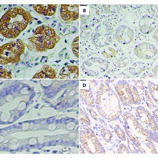 Expression Of Prdx And E Ca Protein In Gc Tissue Immunohistochemistry