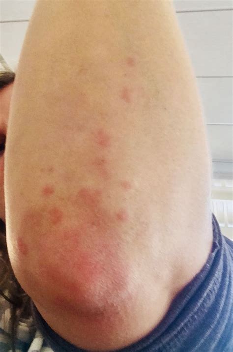 Dermatitis Herpetiformis Elbow Autoimmune Disorder Thoracic