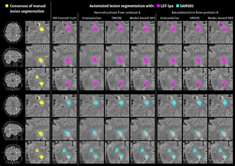 Figure 3 From Super Resolution Reconstruction Of Multi Slice T2 W Flair Mri Improves Multiple