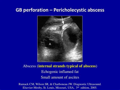 Ultrasound of acute & chronic cholecystitis