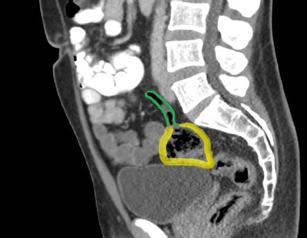 Mobile Cecum Radiology Case Radiopaedia Org