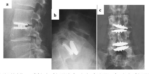 Figure 1 from Total disc replacement. | Semantic Scholar