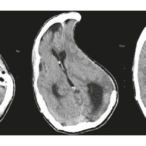 Ct Head Showing Left Sided Prior Craniectomy With Significant Midline