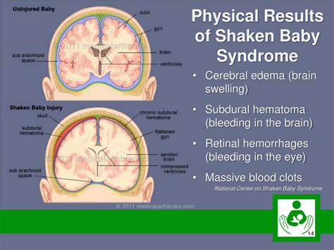 PPT Never Shake A Baby Preventing Shaken Baby Syndrome SBS