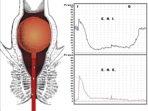 Manometr A Anorrectal Cl Nica Motilidad