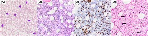 (A) Peripheral blood showing lymphocytosis mostly accounted for by ...