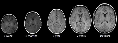 Normale Hersenontwikkeling De Hersenen Brain Body Balance