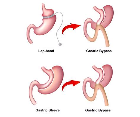 Revisional Bariatric Revision Surgery Booking Surgery