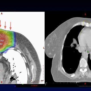 Accelerated Partial Breast Irradiation Delivered With Protons For Very