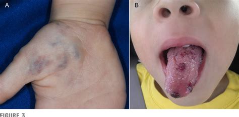 Pdf Diagnosis And Management Of Infantile Hemangioma Semantic Scholar