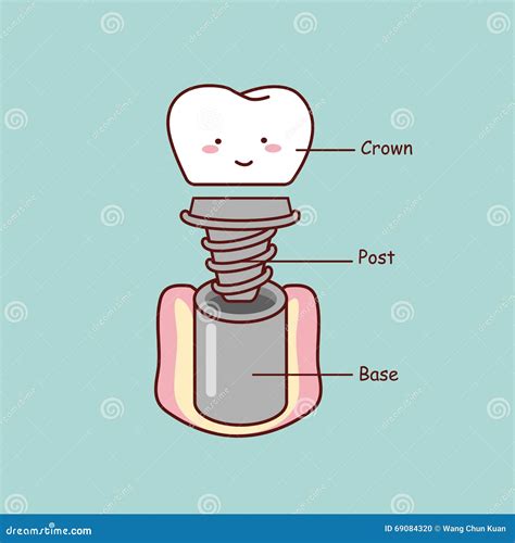 Anatomia Bonito Do Implante Do Dente Dos Desenhos Animados Ilustração