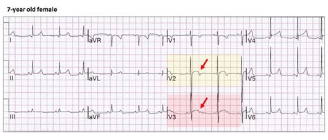 T Wave Elevation