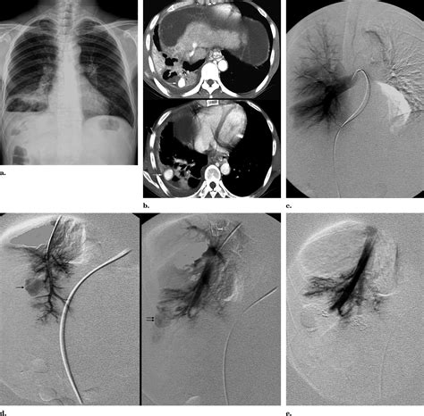 The Role Of Pulmonary CT Angiography And Selective Pulmonary